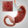 Gastriit või erosiooni mao: peamine sümptomid, ravi, toitumine