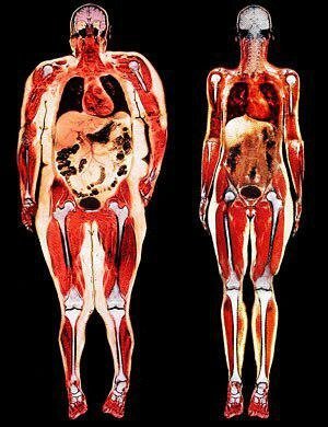 Vasak - lihtsalt vistseraalne rasvumine. Kõik organid lämmatas rasvaga.