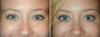 Mis kombinatsioon kosmeetilised protseduurid bombichesky mõju oma nägu