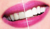 Kuidas valgendama hambaid kodus? hambaravi nõu.