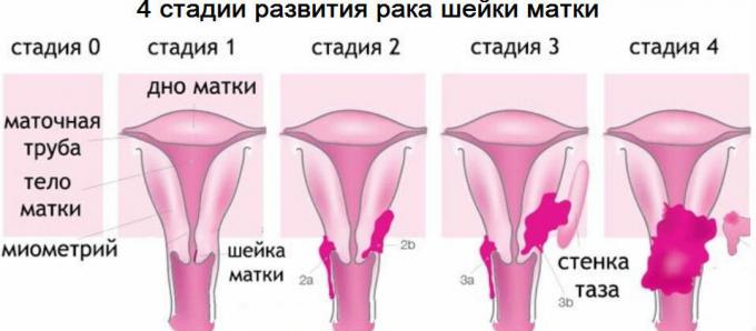 4 etappi emakakaelavähi