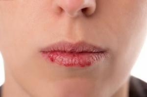 5 nõuanded, kuidas vältida chapping huulte